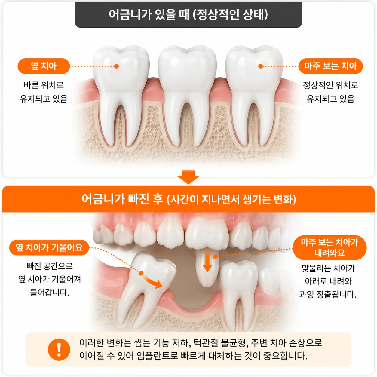 치아 상실 후 인접 치아 기울어짐과 마주 보는 치아의 정출을 나타낸 그림