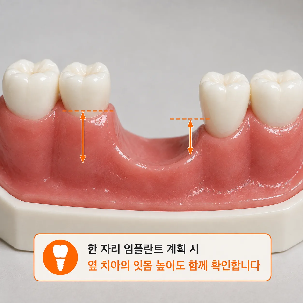 한 자리 임플란트 계획에서 옆 치아 잇몸까지 확인하는 이유
