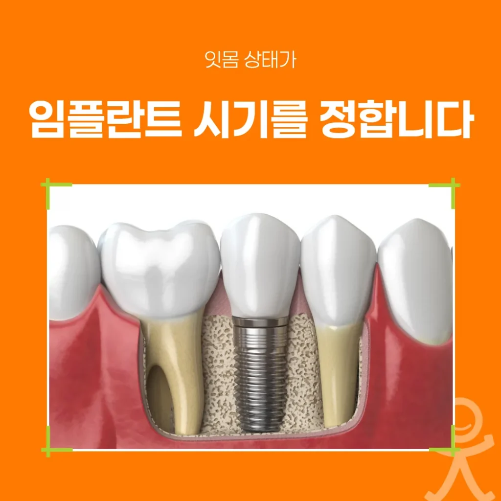 잇몸 상태가 임플란트 시기를 정합니다 (하남)