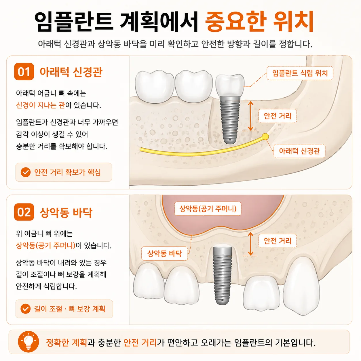 아래턱 신경관과 상악동 바닥 위치를 표시한 임플란트 계획 설명 그림
