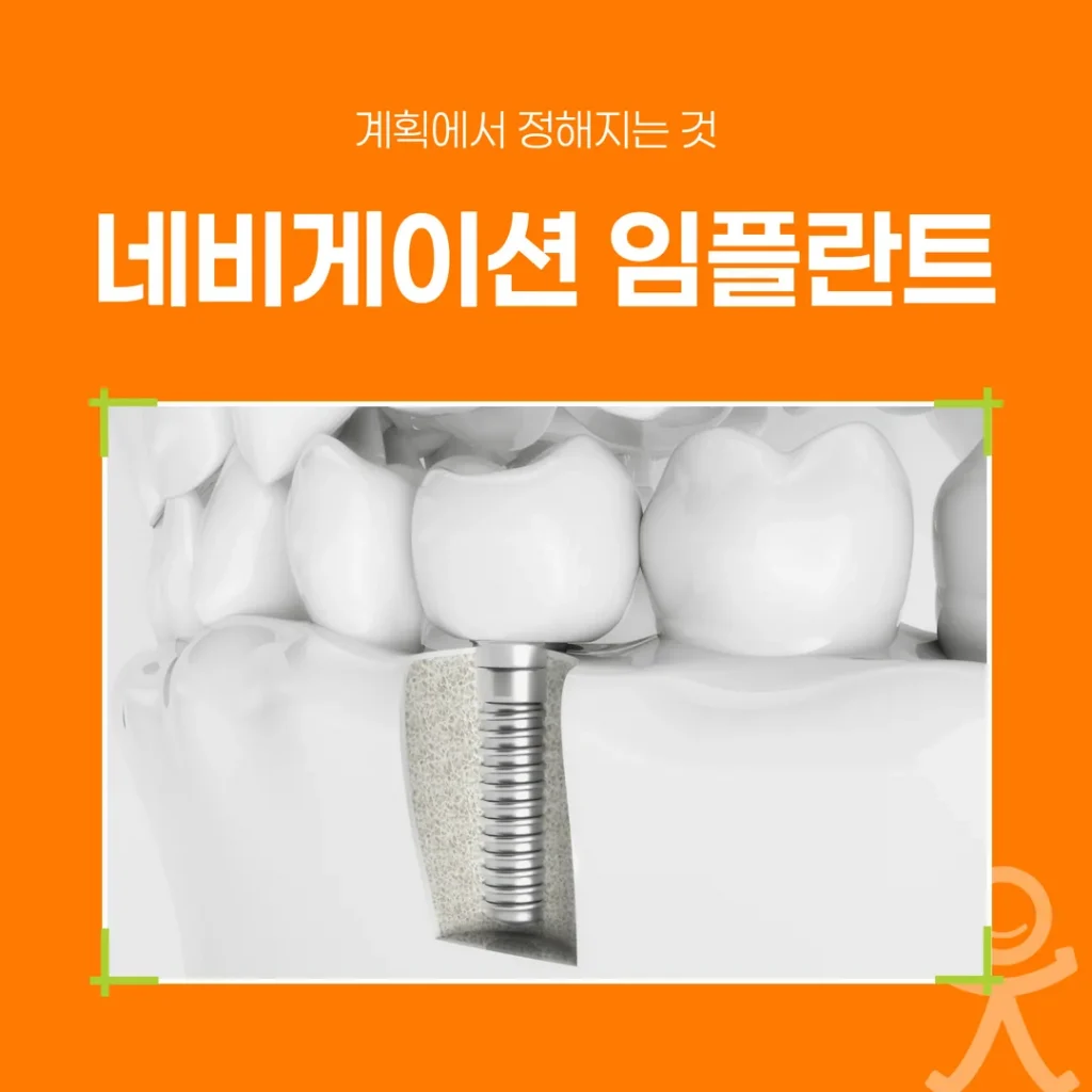 하남 네비게이션 임플란트, 계획에서 정해지는 것