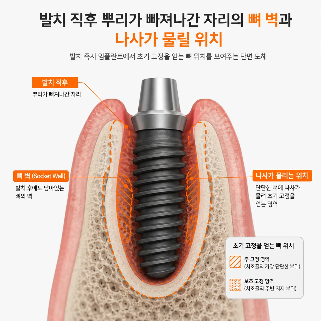 발치 즉시 임플란트에서 초기 고정을 얻는 뼈 위치를 보여 주는 단면 도해