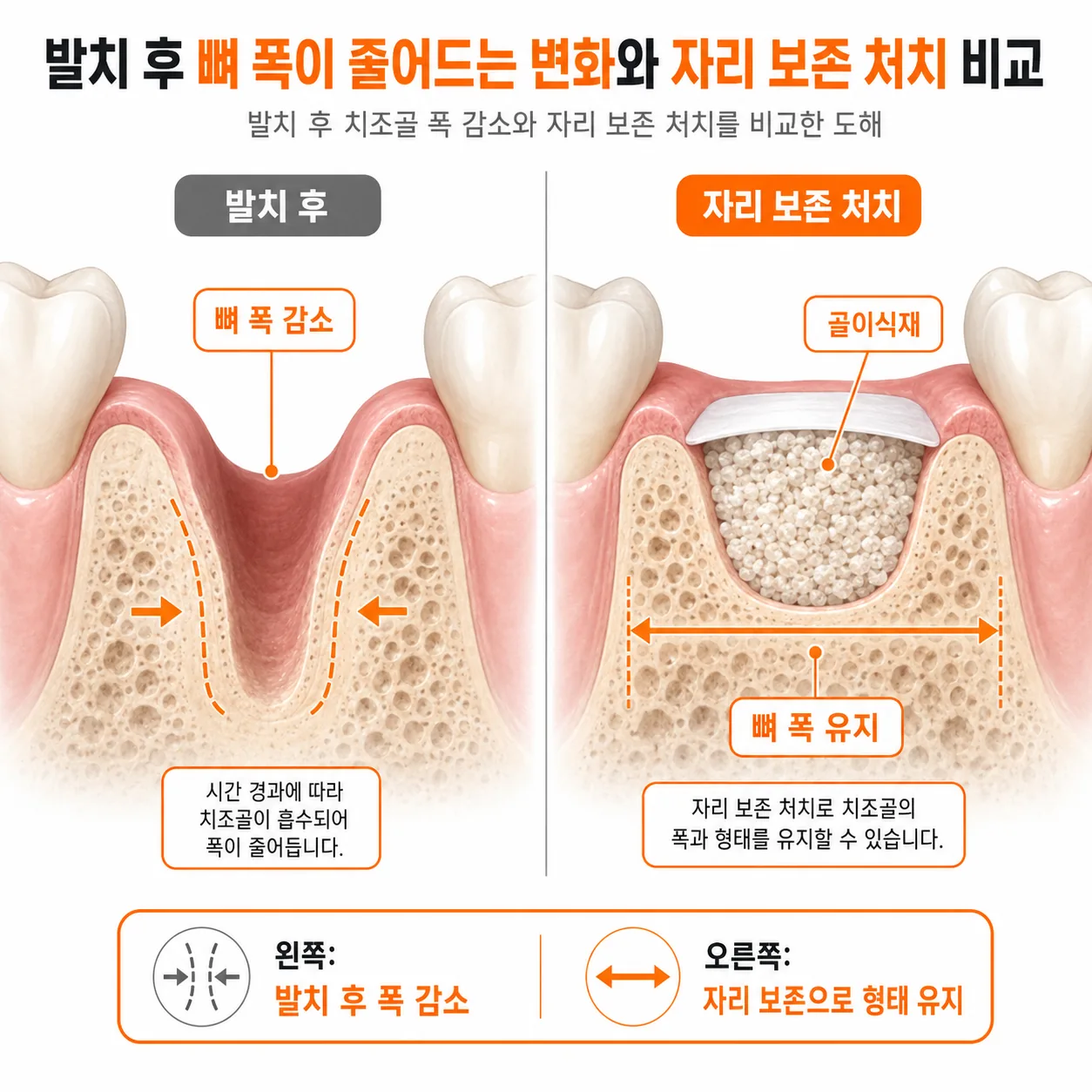 발치 후 치조골 폭 감소와 자리 보존 처치를 비교한 도해
