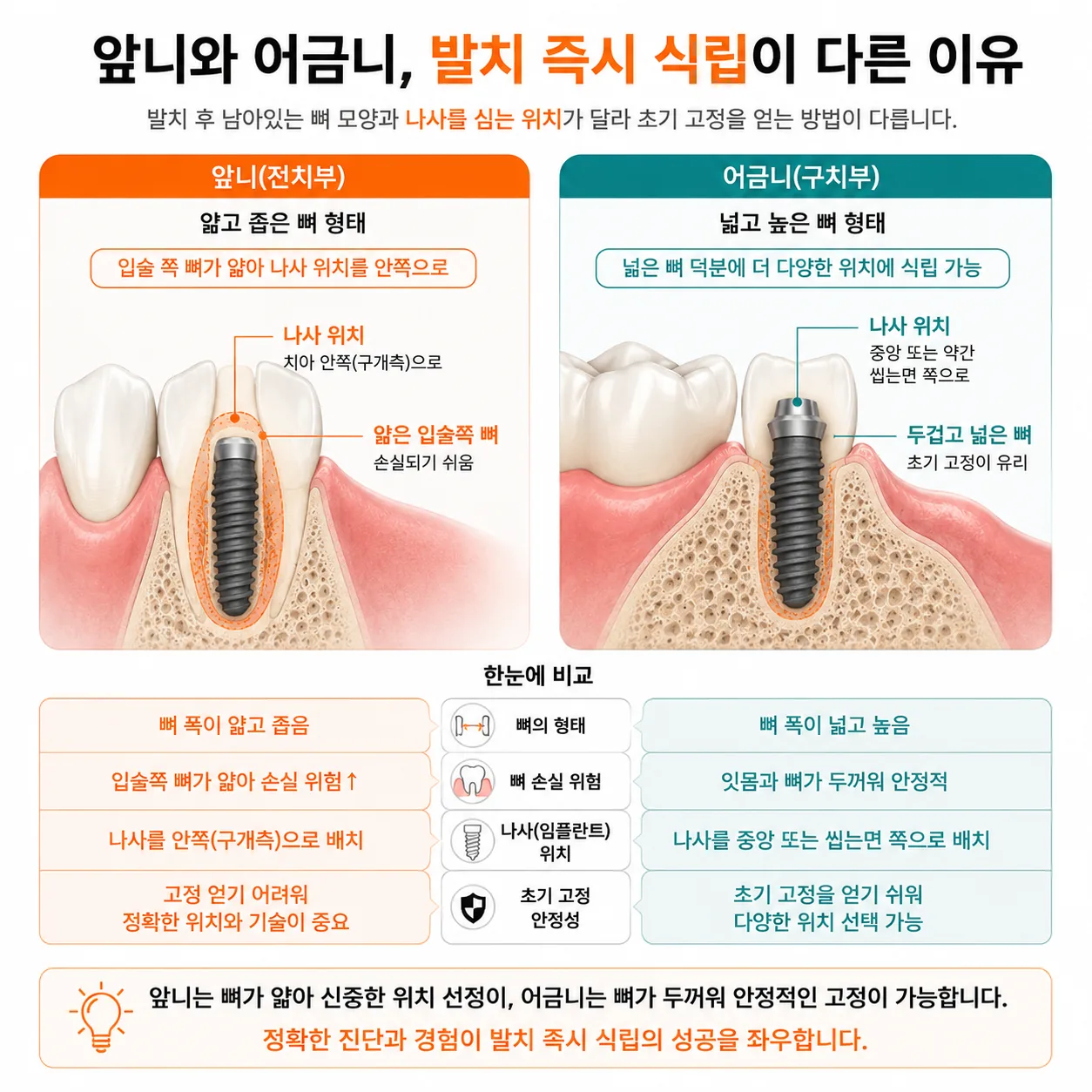 앞니와 어금니에서 발치 즉시 식립 판단이 달라지는 이유를 보여 주는 도해
