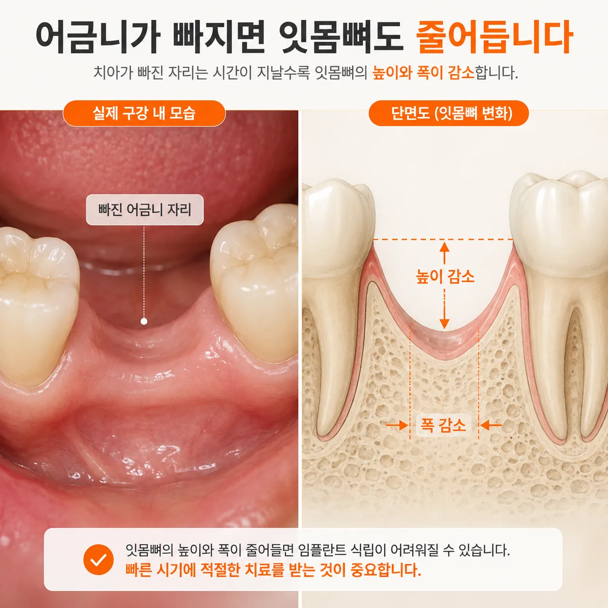 잇몸뼈가 줄어든 발치 부위의 높이와 폭 변화를 보여 주는 도해