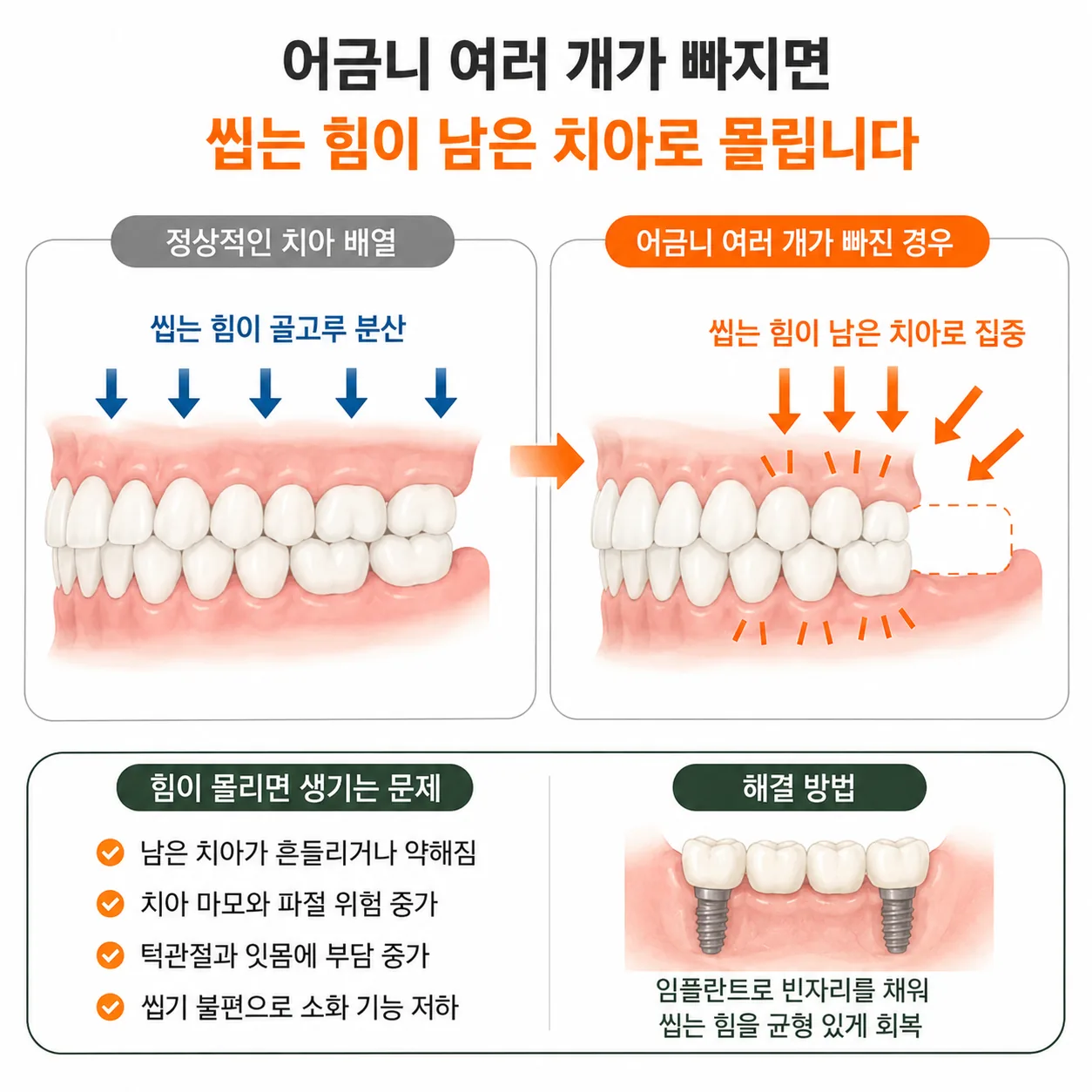 어금니 다수 결손 시 씹는 힘이 남은 치아로 집중되는 모습