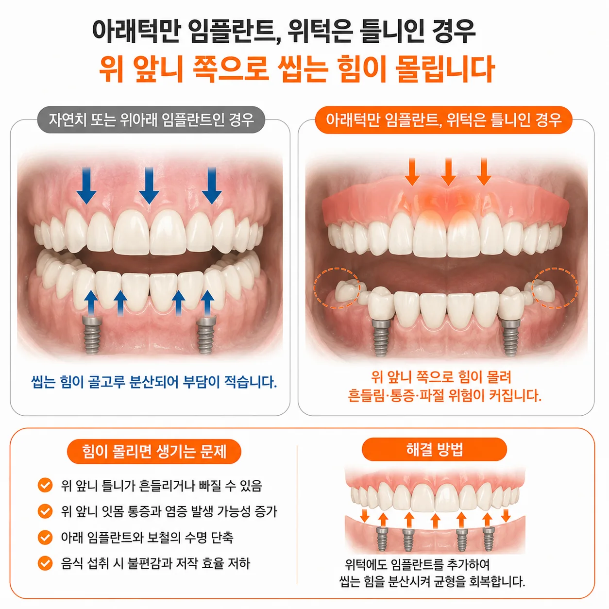 위아래 한쪽만 임플란트한 경우의 교합 부담 비교
