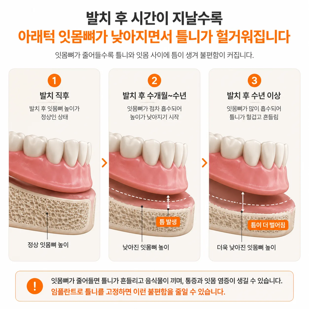잇몸뼈가 줄어들며 아래 틀니가 헐거워지는 과정