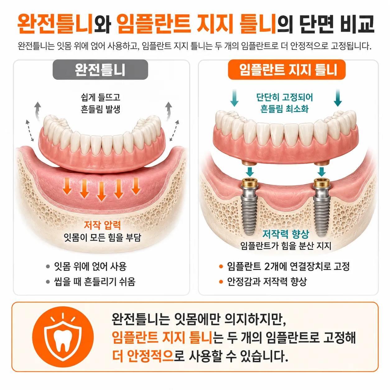 완전틀니와 임플란트 지지 틀니의 단면 비교