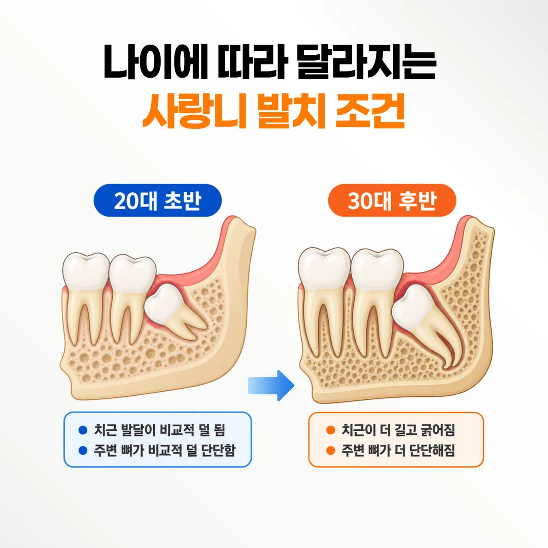 나이에 따른 사랑니 치근 길이와 잇몸뼈 밀도 차이를 비교한 도해