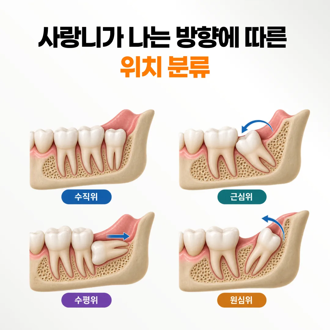 수직위 근심위 수평위 원심위로 나눈 아래턱 사랑니 경사 방향 분류도