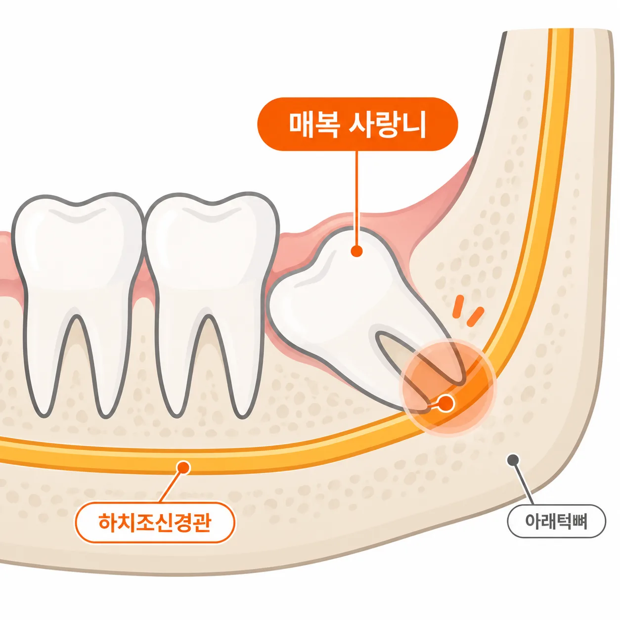 매복 사랑니 뿌리와 아래턱 신경관의 위치 관계