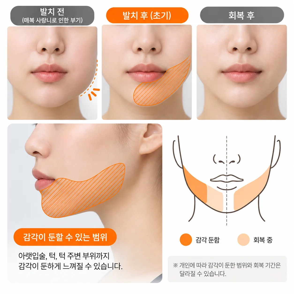 사랑니 발치 후 입술 감각 범위 기록
