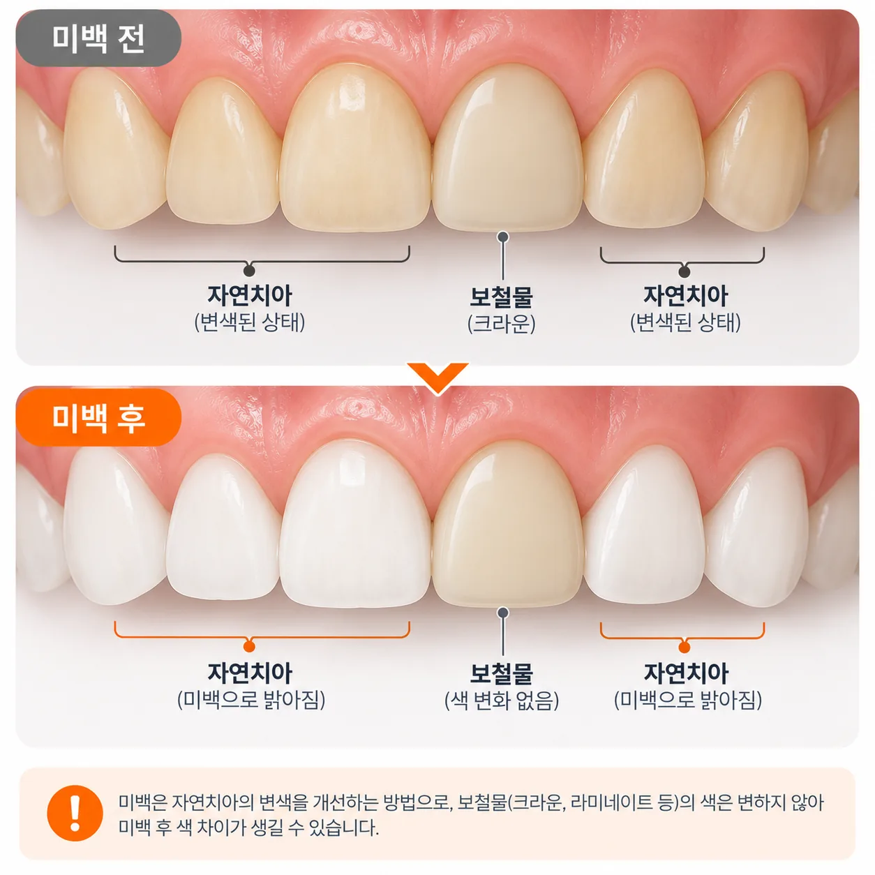 미백 후 자연치아만 밝아지고 보철물은 색이 그대로여서 차이가 생기는 것을 보여 주는 일러스트