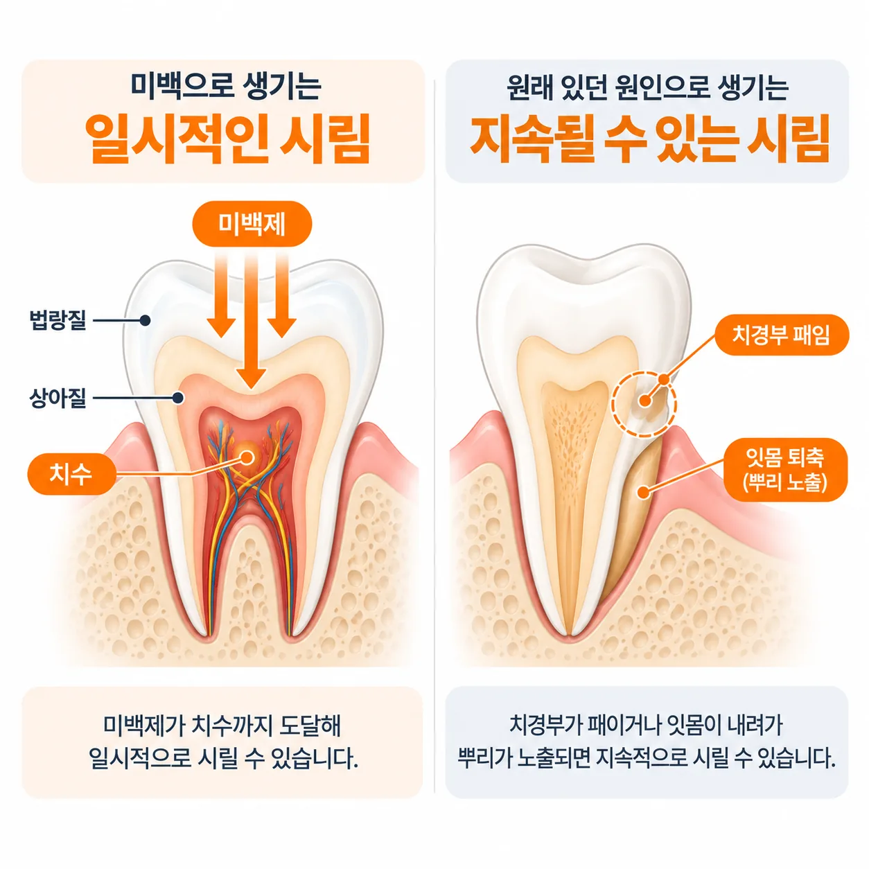 미백제가 치수까지 닿아 생기는 시린 증상과 치경부 패임·잇몸 퇴축으로 생기는 시린 증상의 출발점 차이를 보여 주는 치아 단면 도식