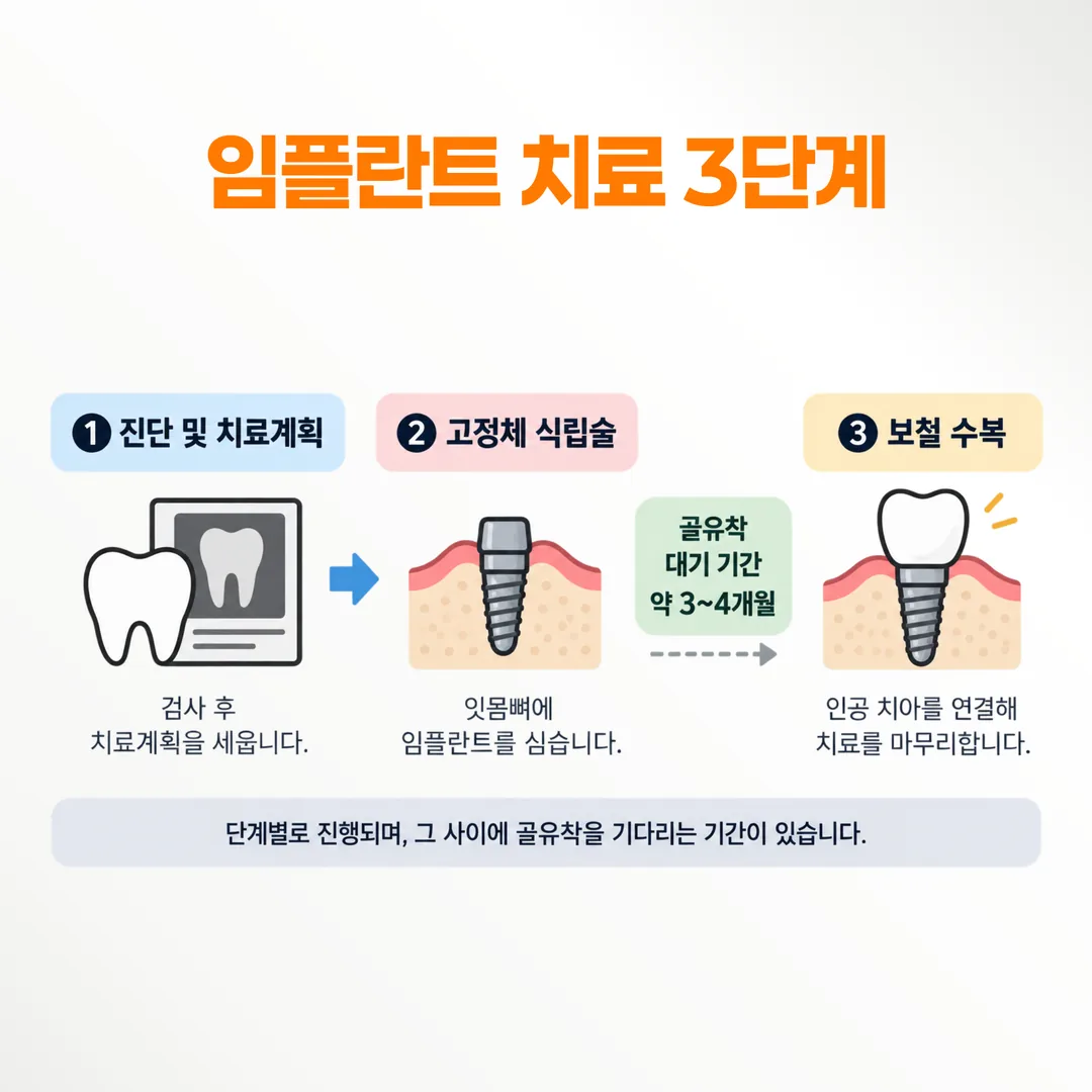임플란트 세 단계와 그 사이의 골유착 대기 기간을 나타낸 흐름도