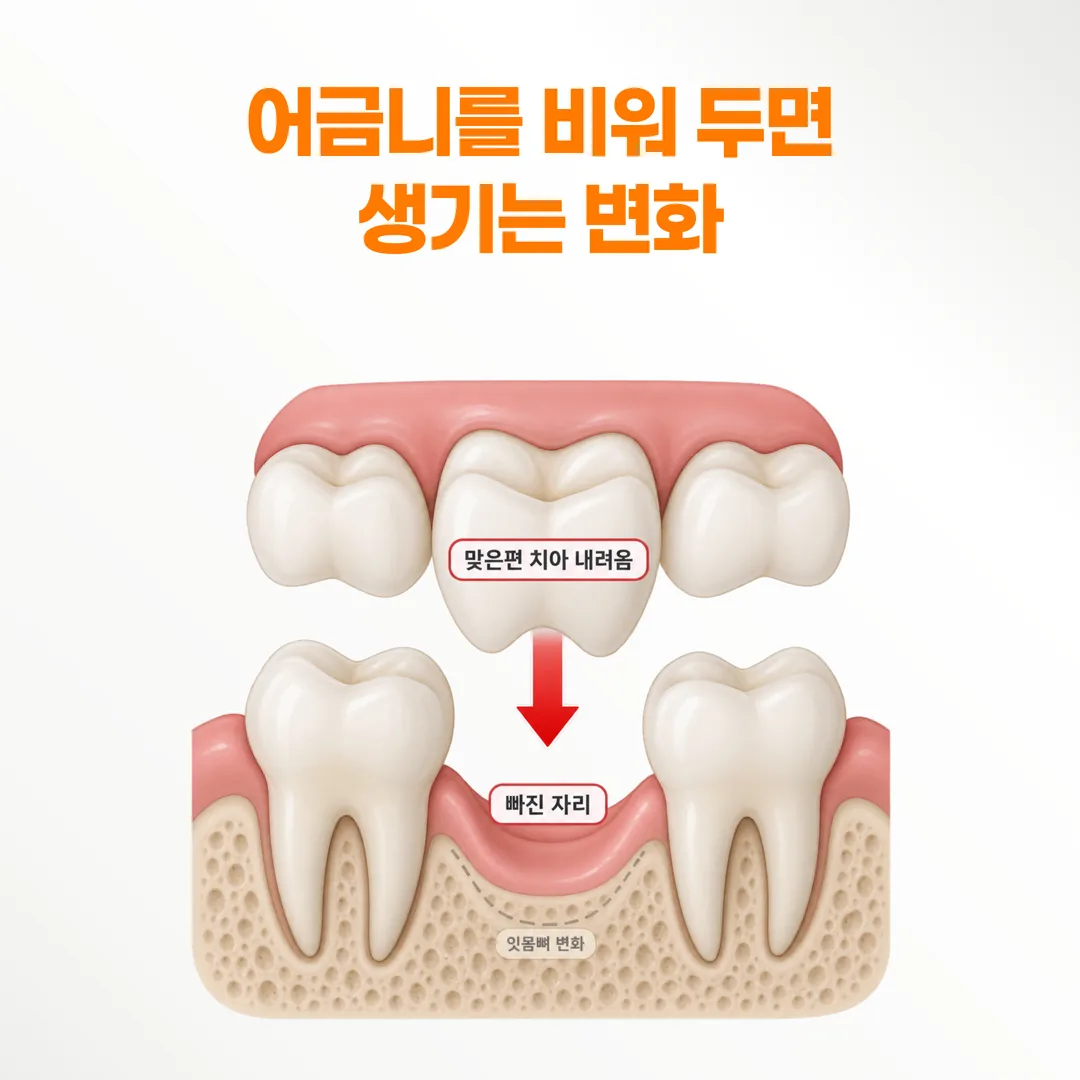 어금니 한 개가 빠진 자리와 맞은편 치아가 내려온 변화를 보여 주는 개념도