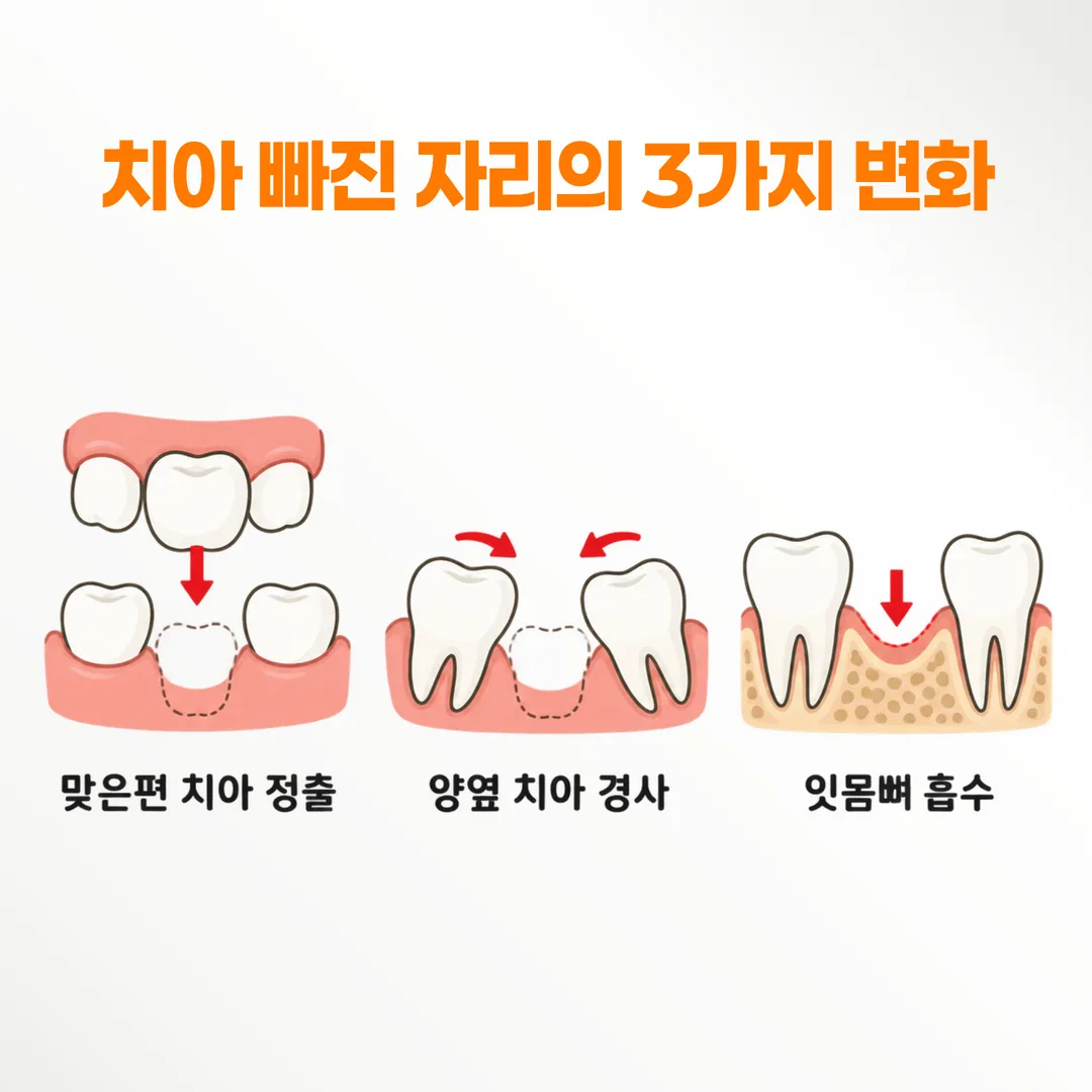 치아 상실 후 나타나는 정출·경사·잇몸뼈 흡수 세 가지 변화를 나란히 표시한 도식