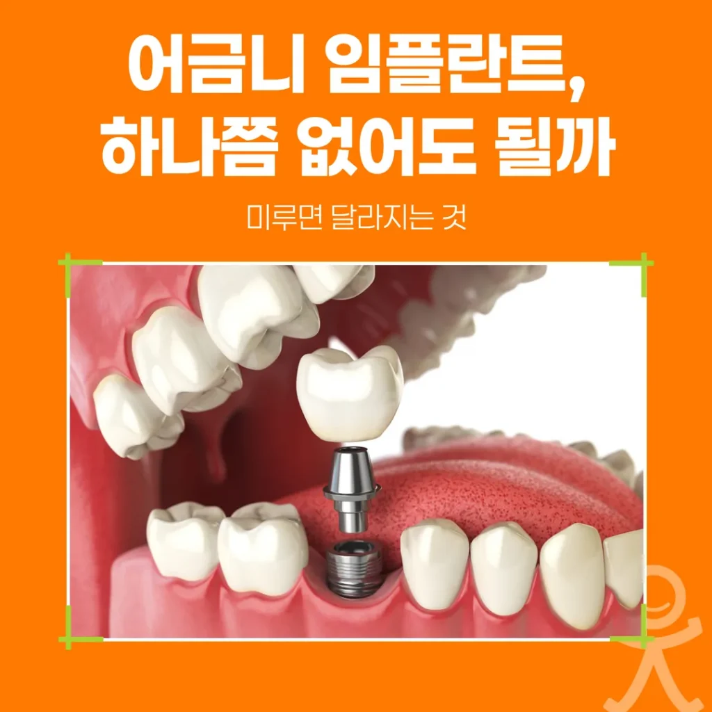어금니 임플란트, 하나쯤 없어도 될까 — 미루면 달라지는 것