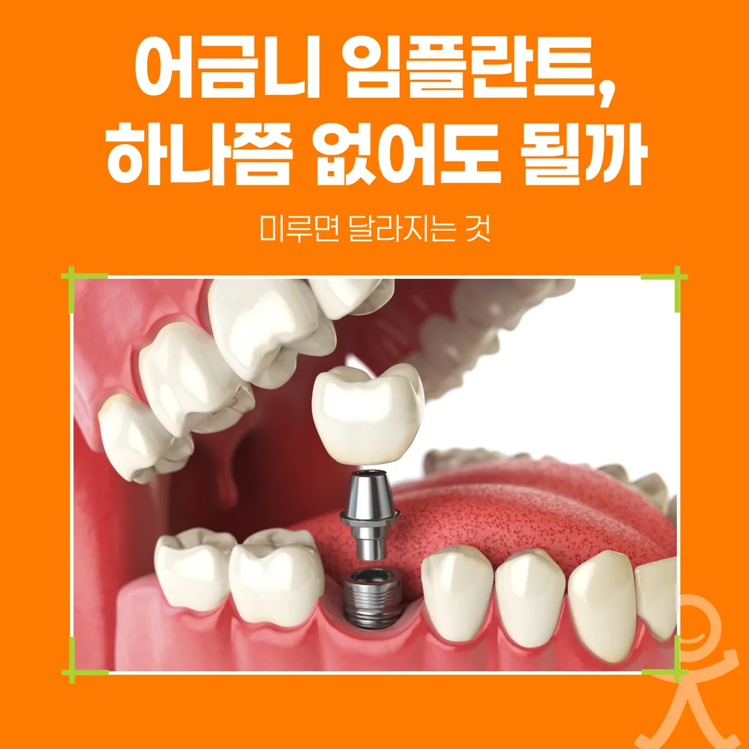 어금니 임플란트, 하나쯤 없어도 될까 — 미루면 달라지는 것