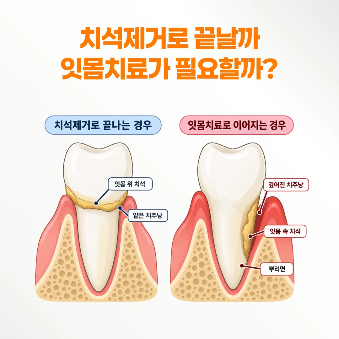 치석 위치에 따라 치석제거로 끝나는 경우와 잇몸 속 치료로 넘어가는 경우를 비교한 잇몸 단면 개념도