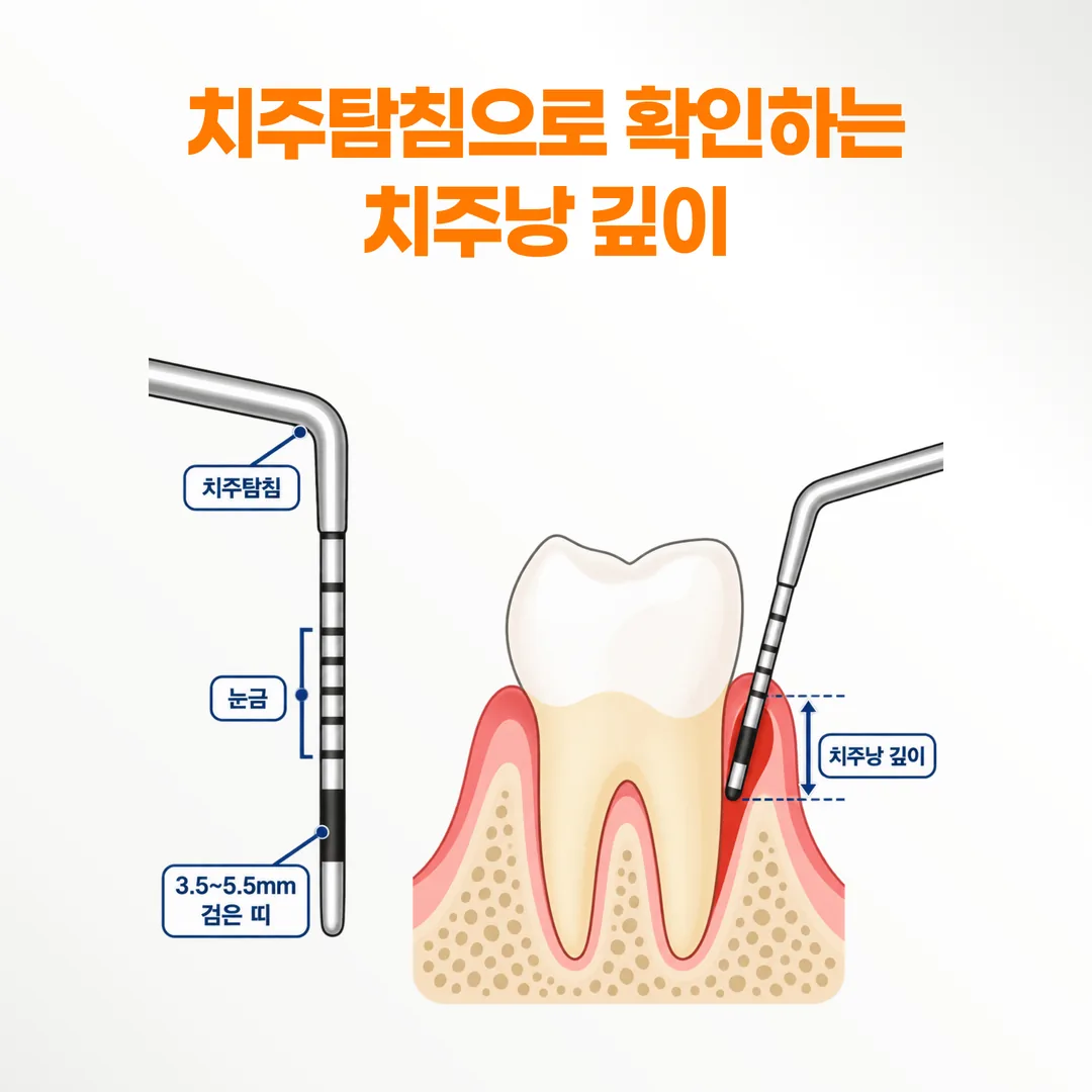 치주탐침 끝 3.5~5.5mm 검은 띠가 잇몸 속으로 들어가는 정도를 보여 주는 그림