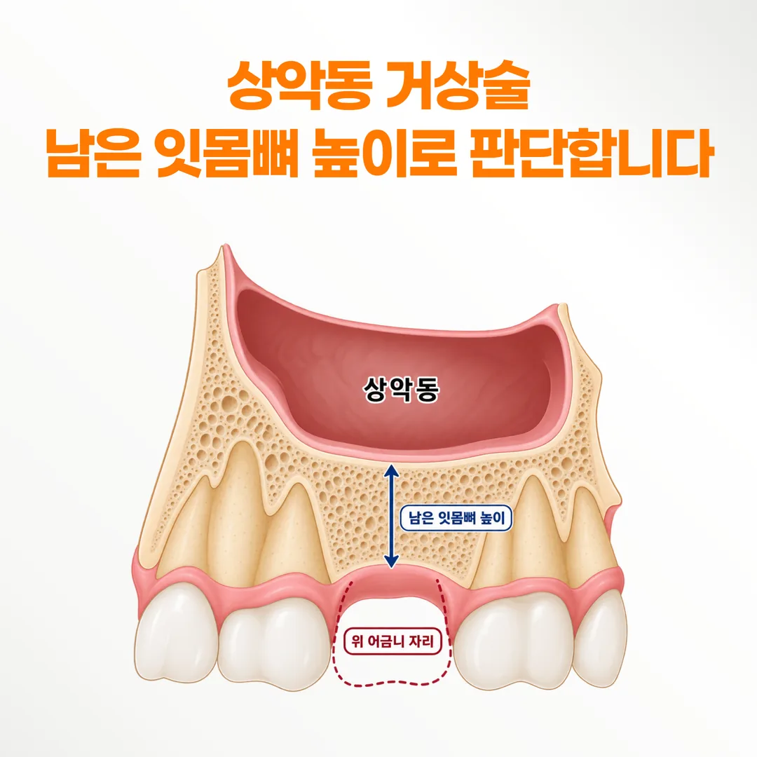 위 어금니 자리에서 상악동 아래 남은 잇몸뼈 높이를 표시한 단면 개념도