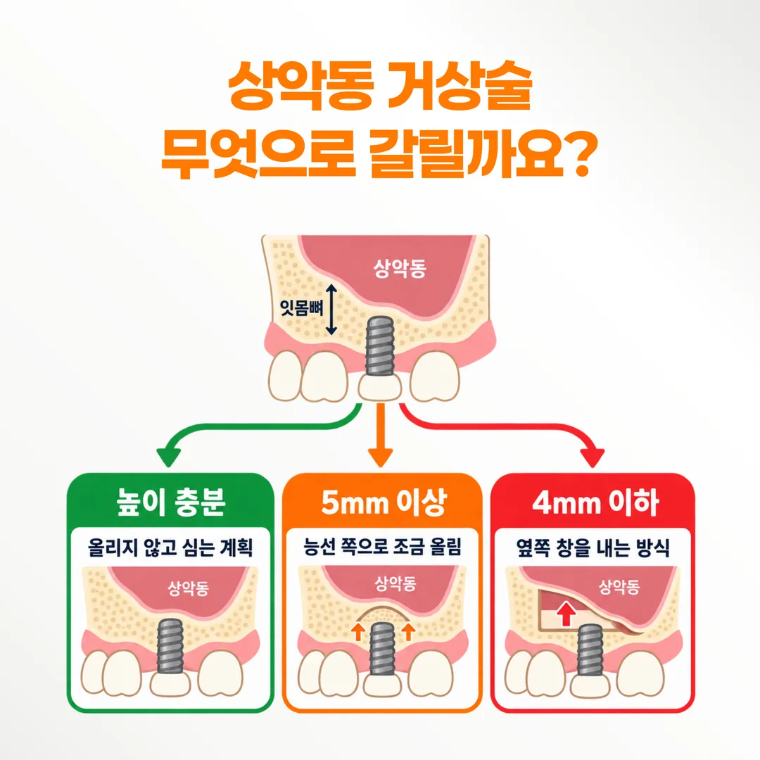 남은 잇몸뼈 높이에 따라 세 갈래로 나뉘는 위 어금니 임플란트 계획 도식