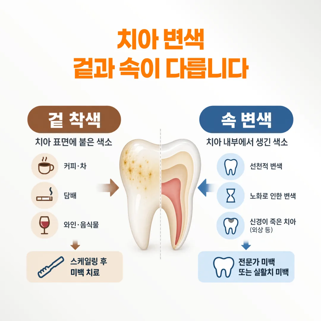 겉 착색과 속 변색을 나눈 치아 변색 개념도