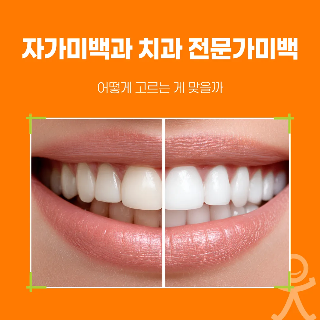 자가미백과 치과 전문가미백, 어떻게 고르는 게 맞을까