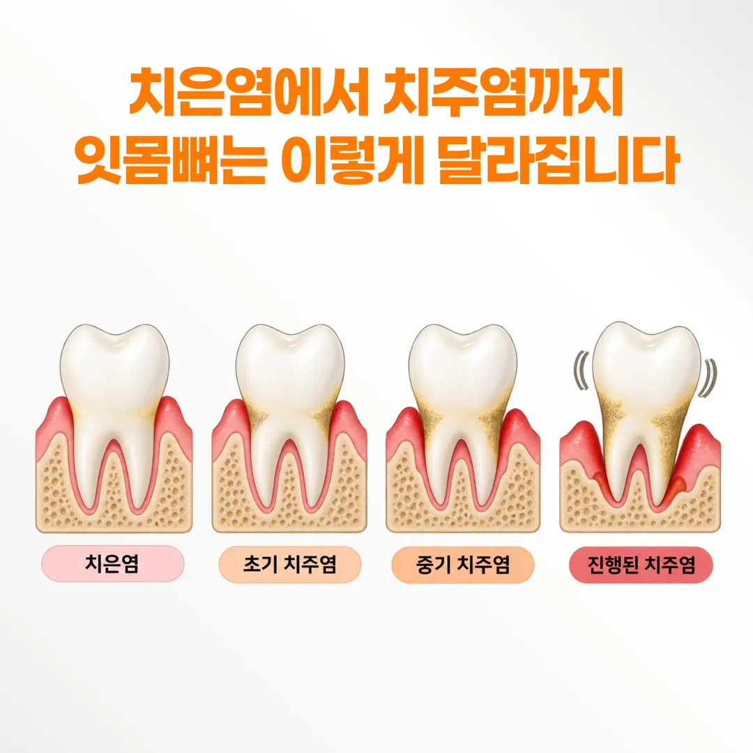 치은염·초기 치주염·중기 치주염·진행된 치주염의 잇몸 선과 잇몸뼈 높이를 비교한 단면 개념도