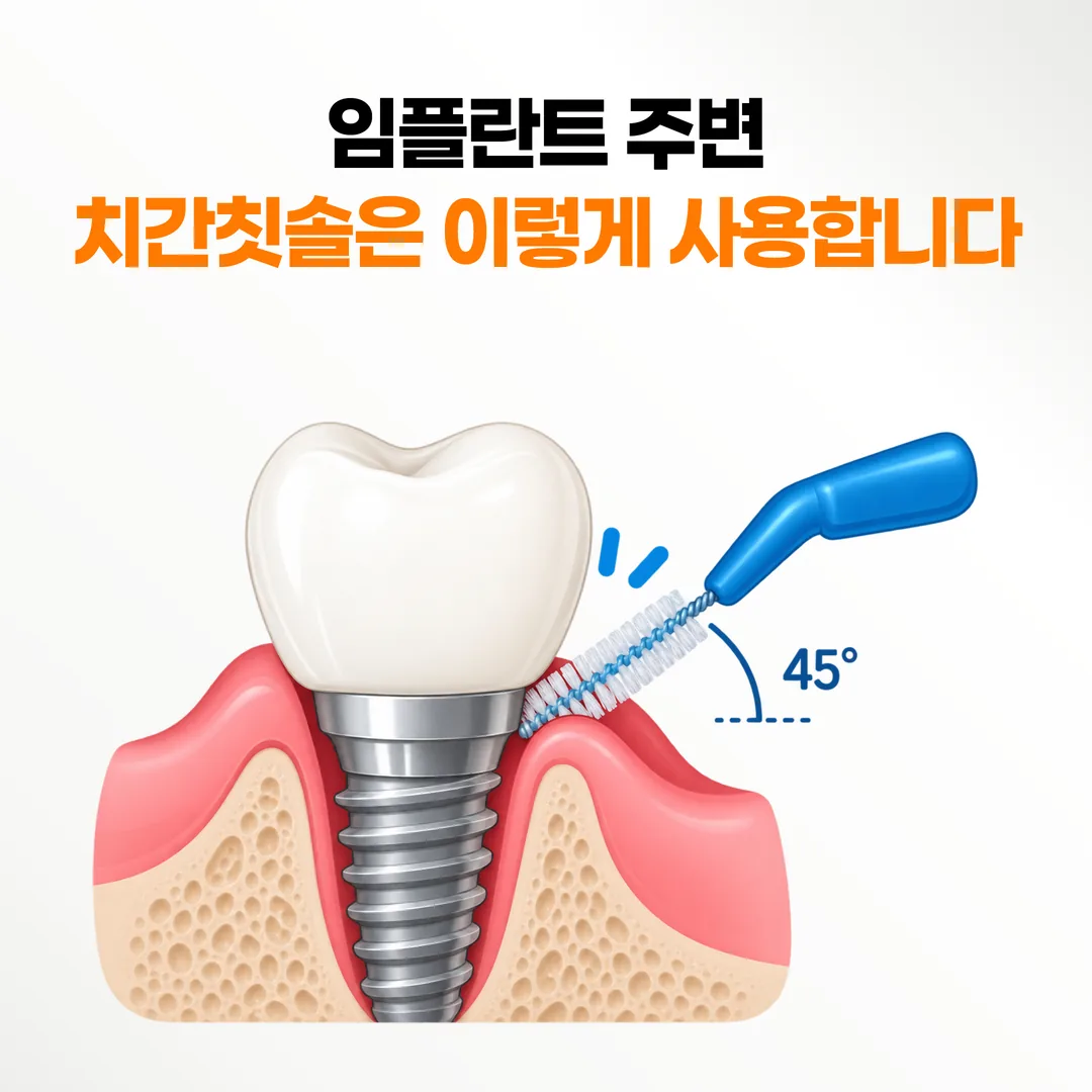 임플란트와 잇몸이 만나는 경계를 치간칫솔로 닦는 각도를 보여 주는 단면 그림
