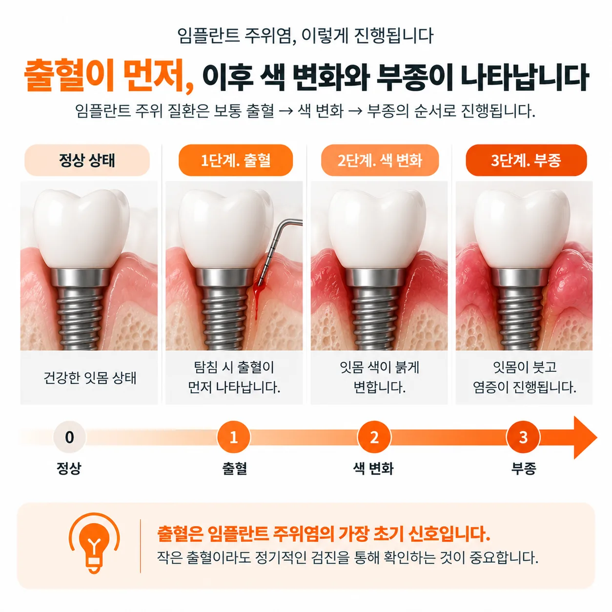 임플란트 주위 질환에서 탐침 시 출혈이 색 변화나 부종보다 먼저 나타나는 순서를 보여 주는 도식