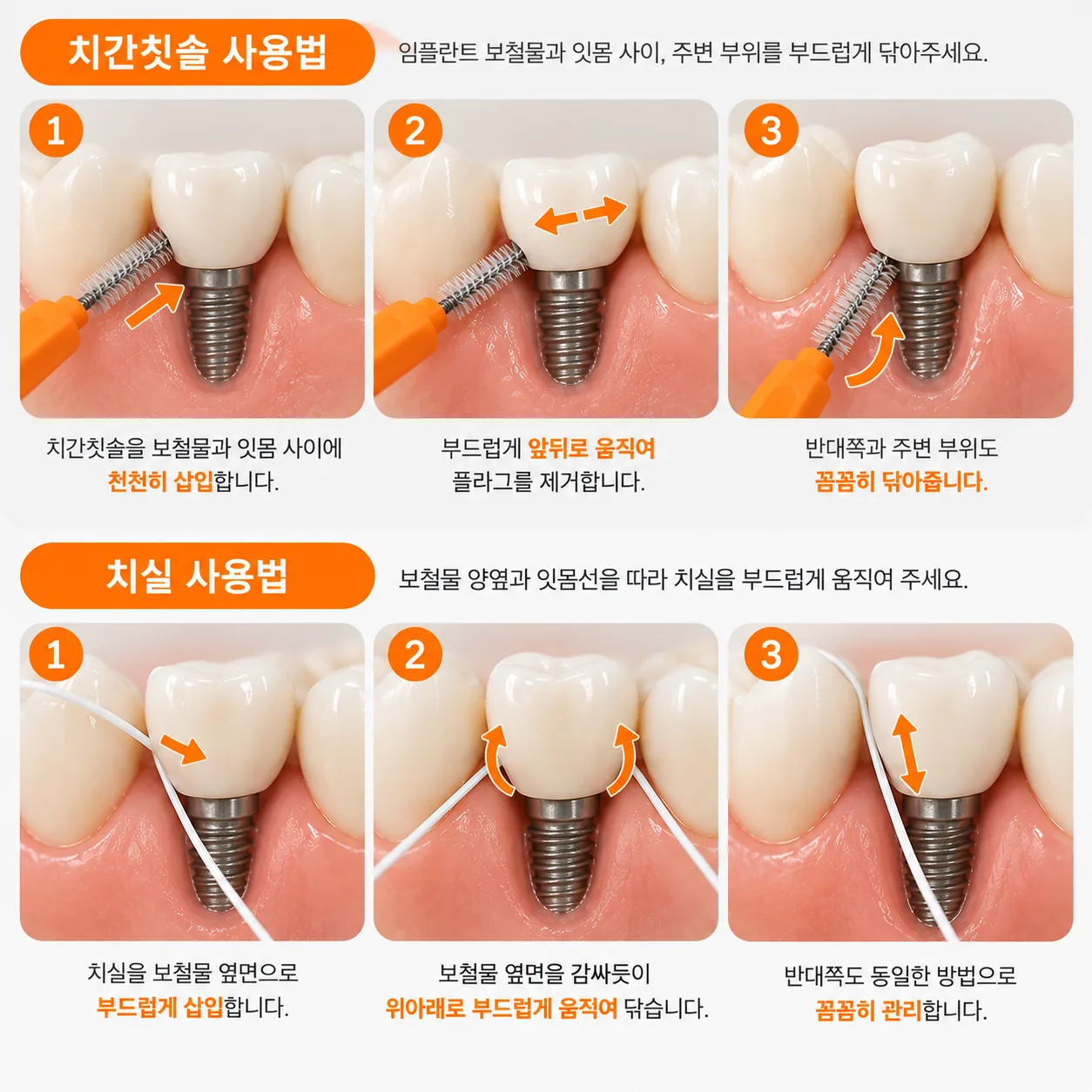 치간칫솔과 치실로 임플란트 보철물 주변을 닦는 방법을 단계별로 보여 주는 도해