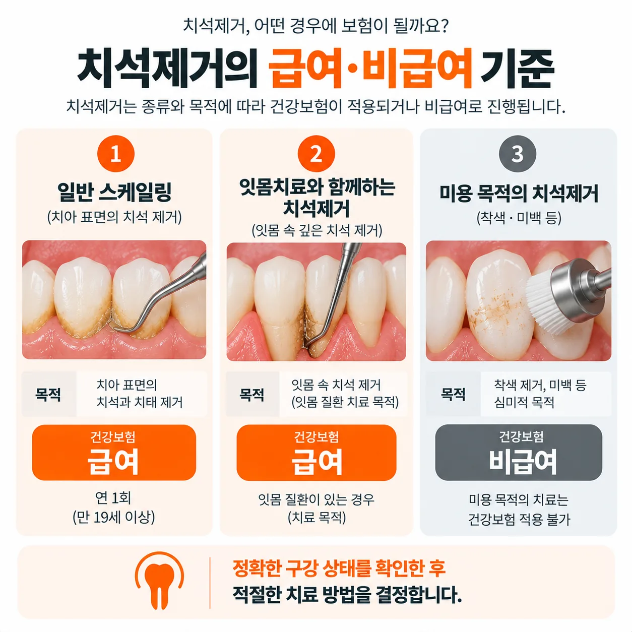 치석제거 건강보험 급여와 비급여가 갈리는 기준 정리