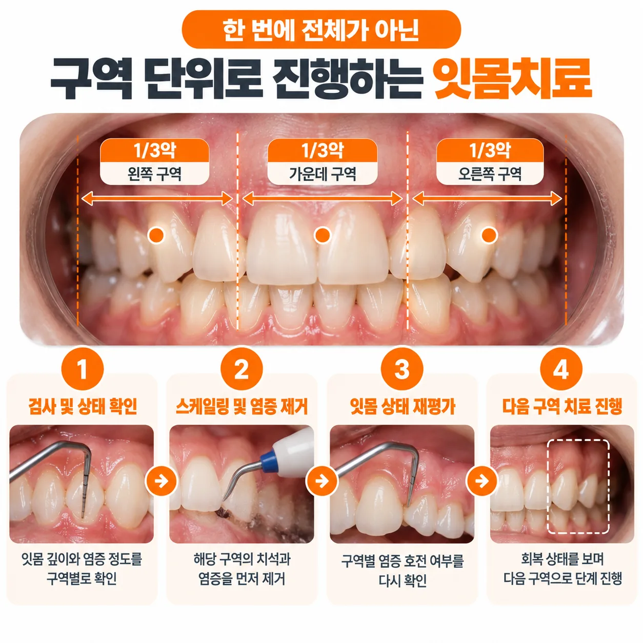 잇몸치료를 1/3악 구역 단위로 나누어 단계를 올려 가며 진행하는 순서 개념도