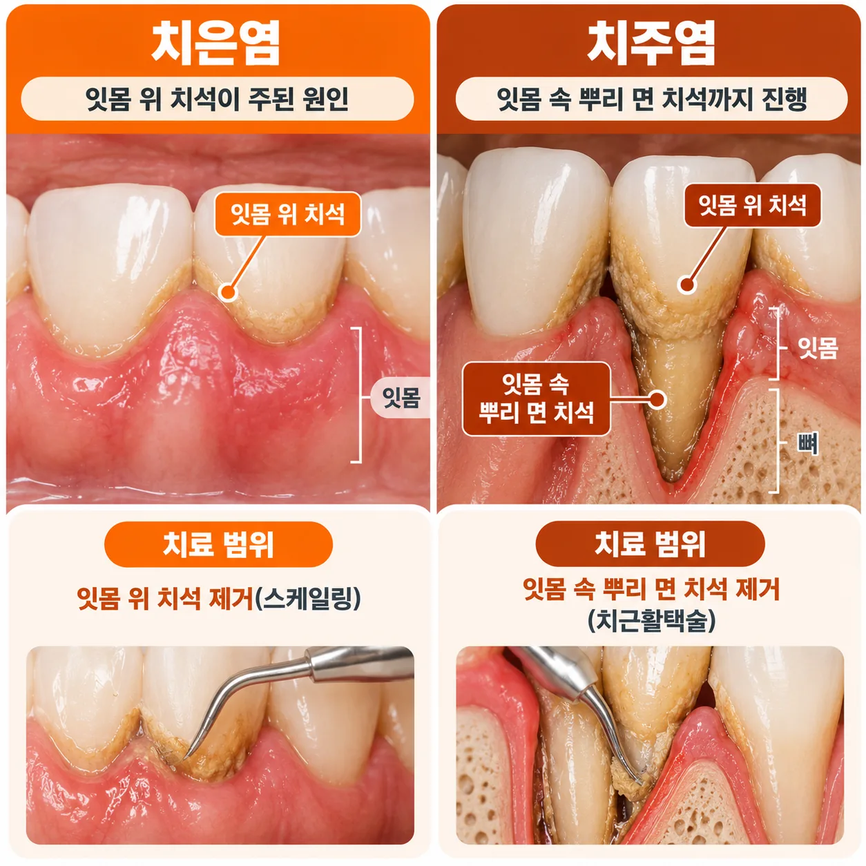잇몸 위 치석과 잇몸 속 뿌리 면 치석에서 치료 범위가 갈리는 지점을 나타낸 그림