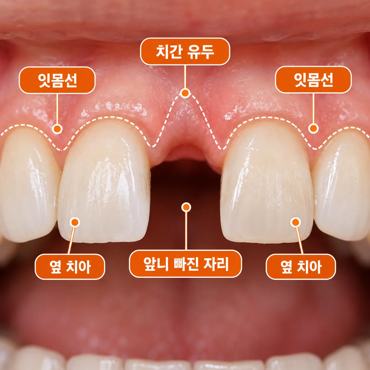 앞니 한 개가 빠진 자리와 양옆 치아, 잇몸선과 치간 유두의 관계를 나타낸 개념도