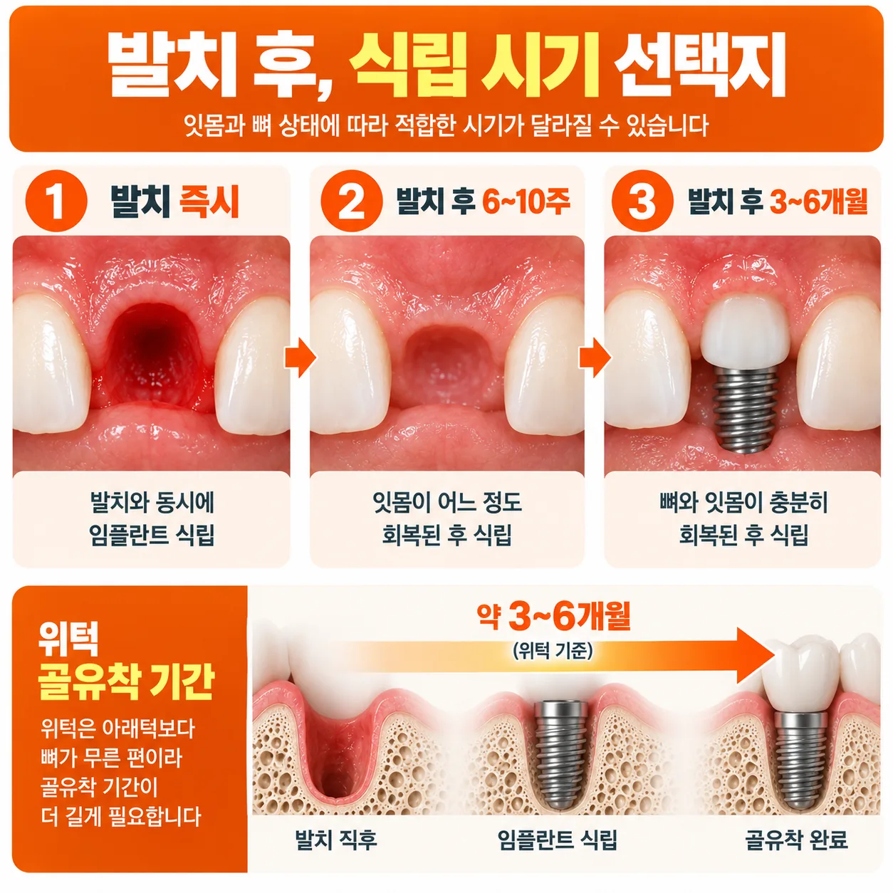 발치 후 식립 시기 세 가지와 위턱 골유착 기간을 나타낸 시간 흐름도