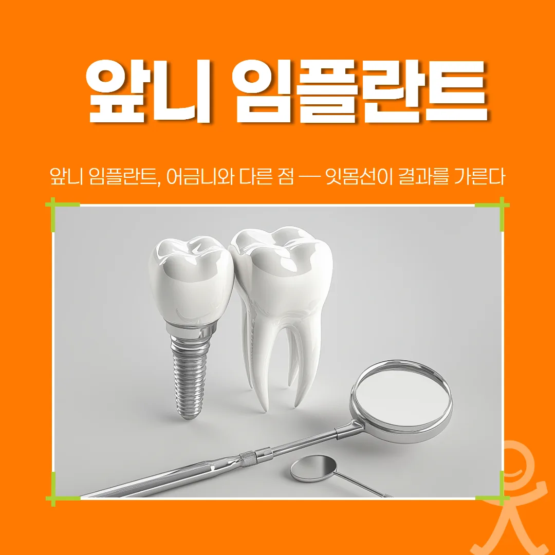 앞니 임플란트, 어금니와 다른 점 — 잇몸선이 결과를 가른다