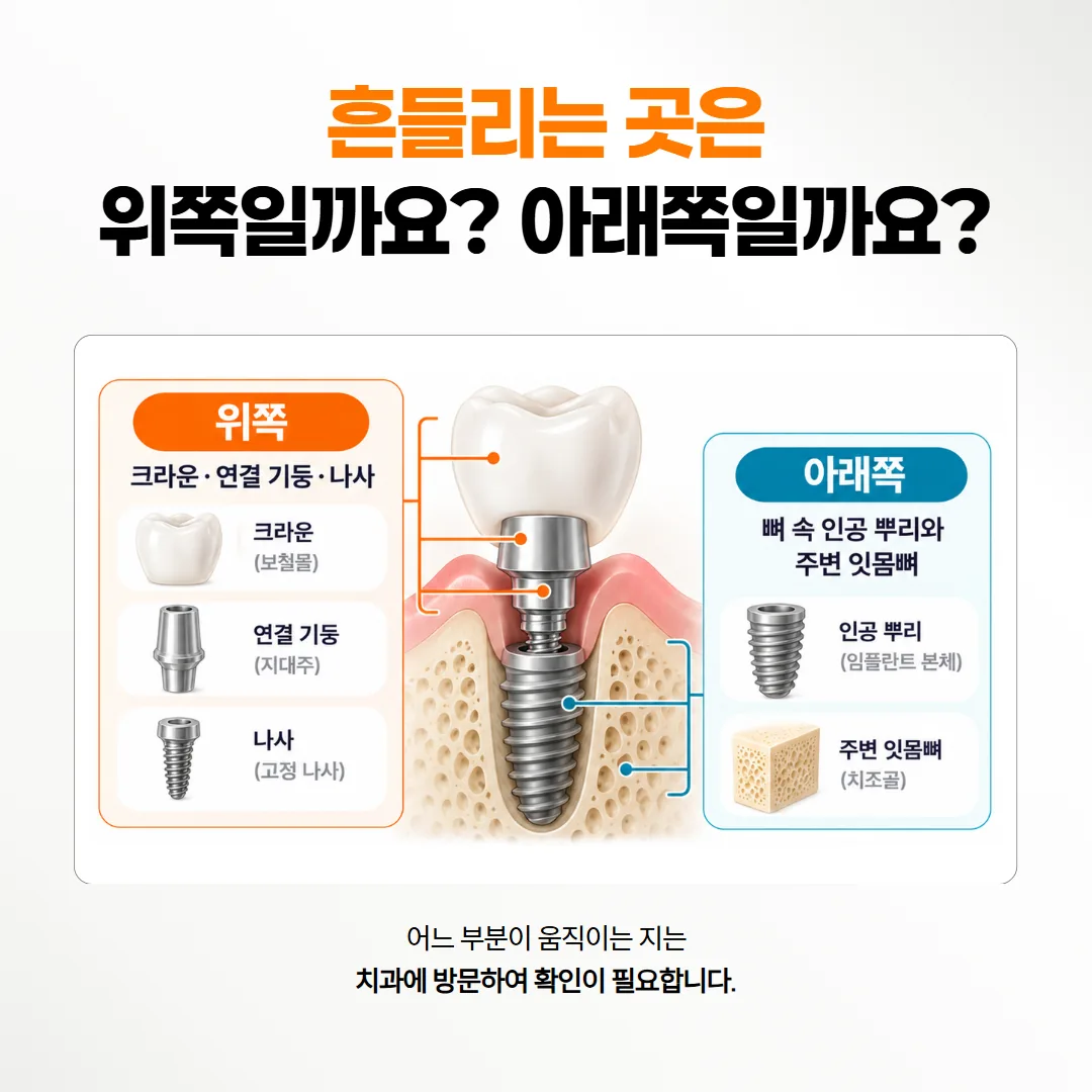 임플란트 흔들림이 생기는 크라운·나사 쪽과 잇몸뼈 쪽을 나눠 보여 주는 구조도