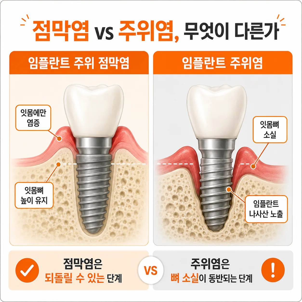 임플란트 주위 점막염과 임플란트 주위염의 잇몸뼈 차이 단면 도식
