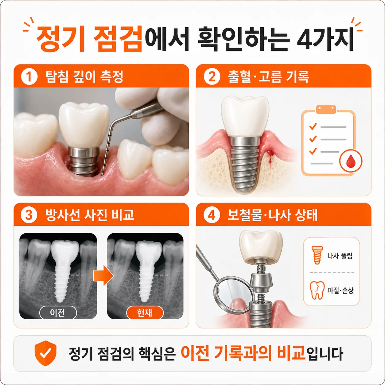 임플란트 정기 점검 확인 항목 네 가지 도식