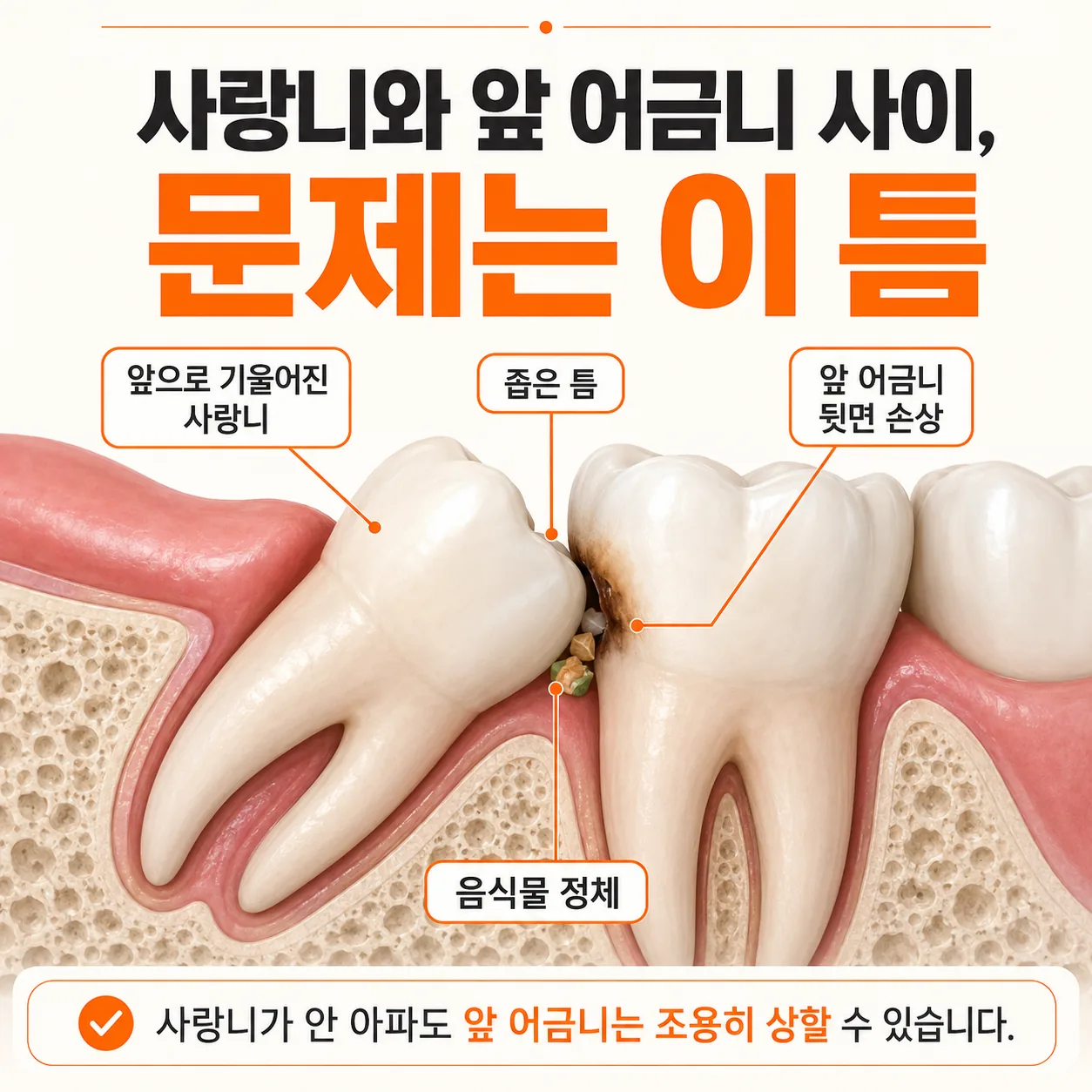 사랑니와 앞 어금니 사이 틈에서 제2대구치 뒷면이 손상되는 위치를 보여주는 단면 도해