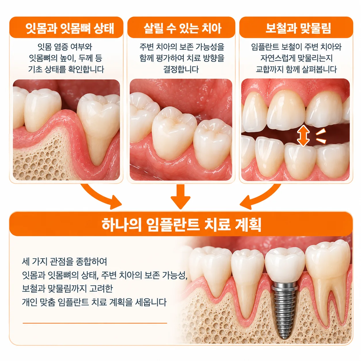 잇몸과 잇몸뼈, 살릴 수 있는 치아, 보철과 맞물림을 함께 보고 하나의 임플란트 계획으로 묶는 개념도
