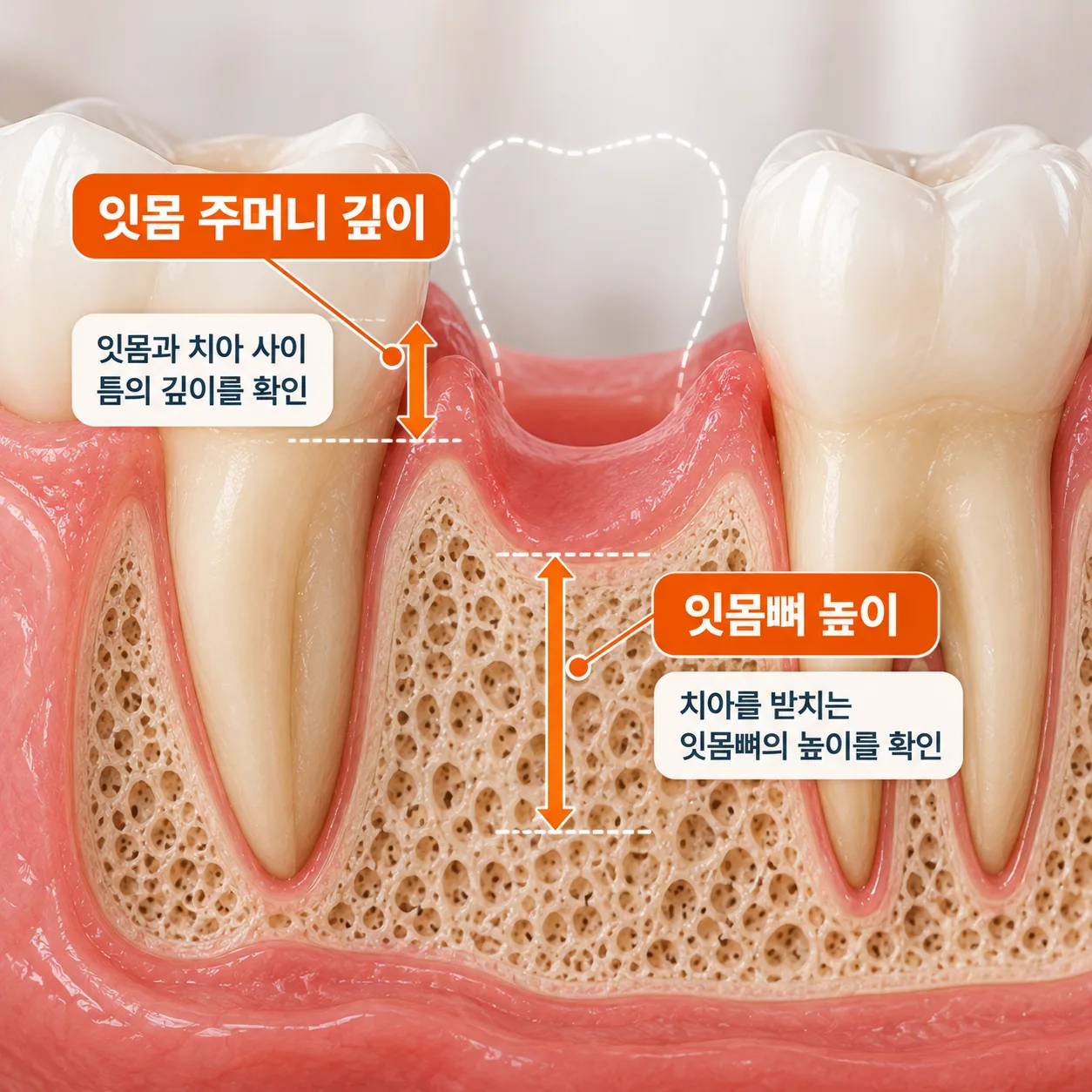 잇몸 주머니 깊이와 잇몸뼈 높이를 빠진 자리 옆 치아까지 표시한 잇몸 단면 그림