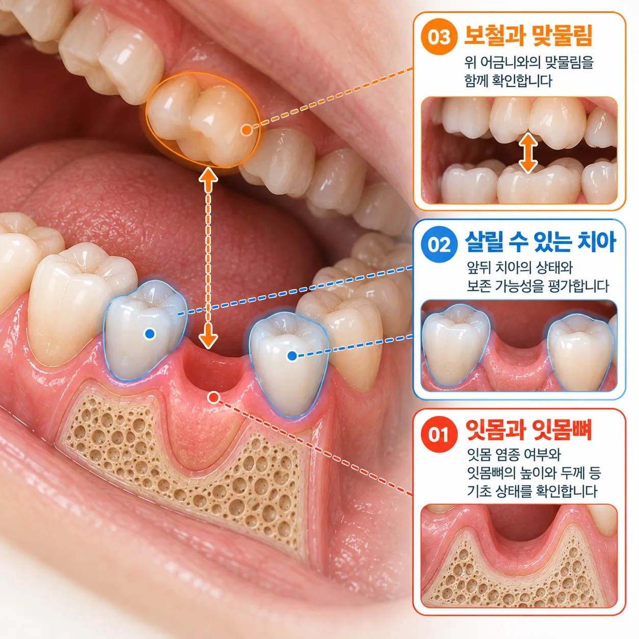 어금니 한 자리가 빈 치열에서 잇몸, 앞뒤 치아, 위아래 맞물림을 세 가지 색으로 나눠 표시한 그림
