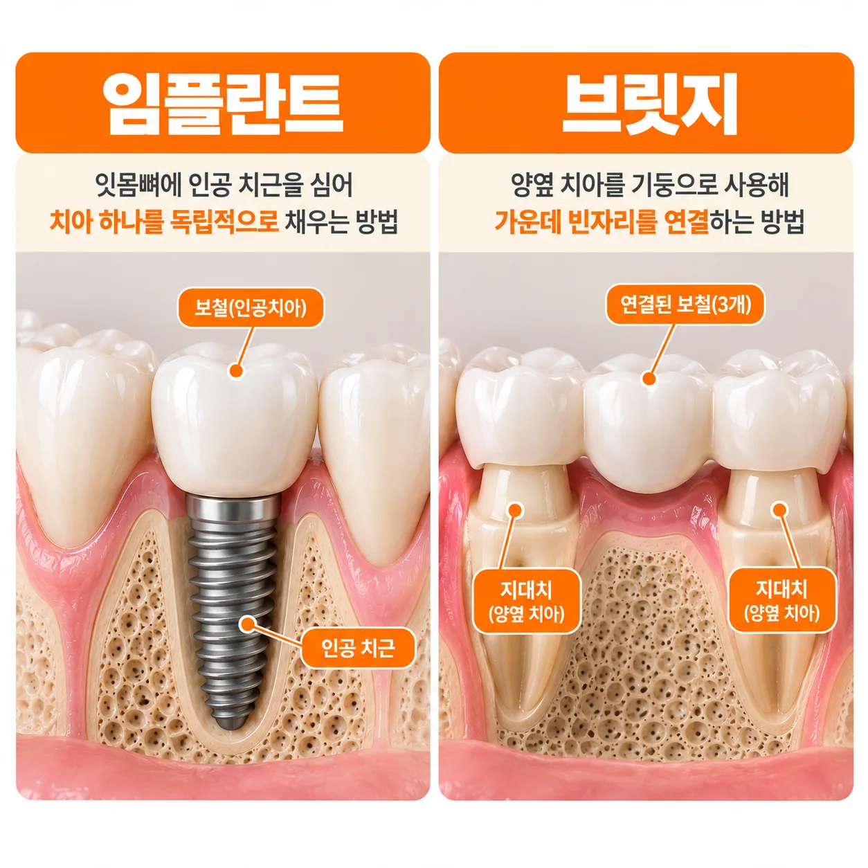 빈자리에 뿌리를 새로 세우는 임플란트와 양옆 치아를 기둥 삼는 브릿지의 구조 비교도
