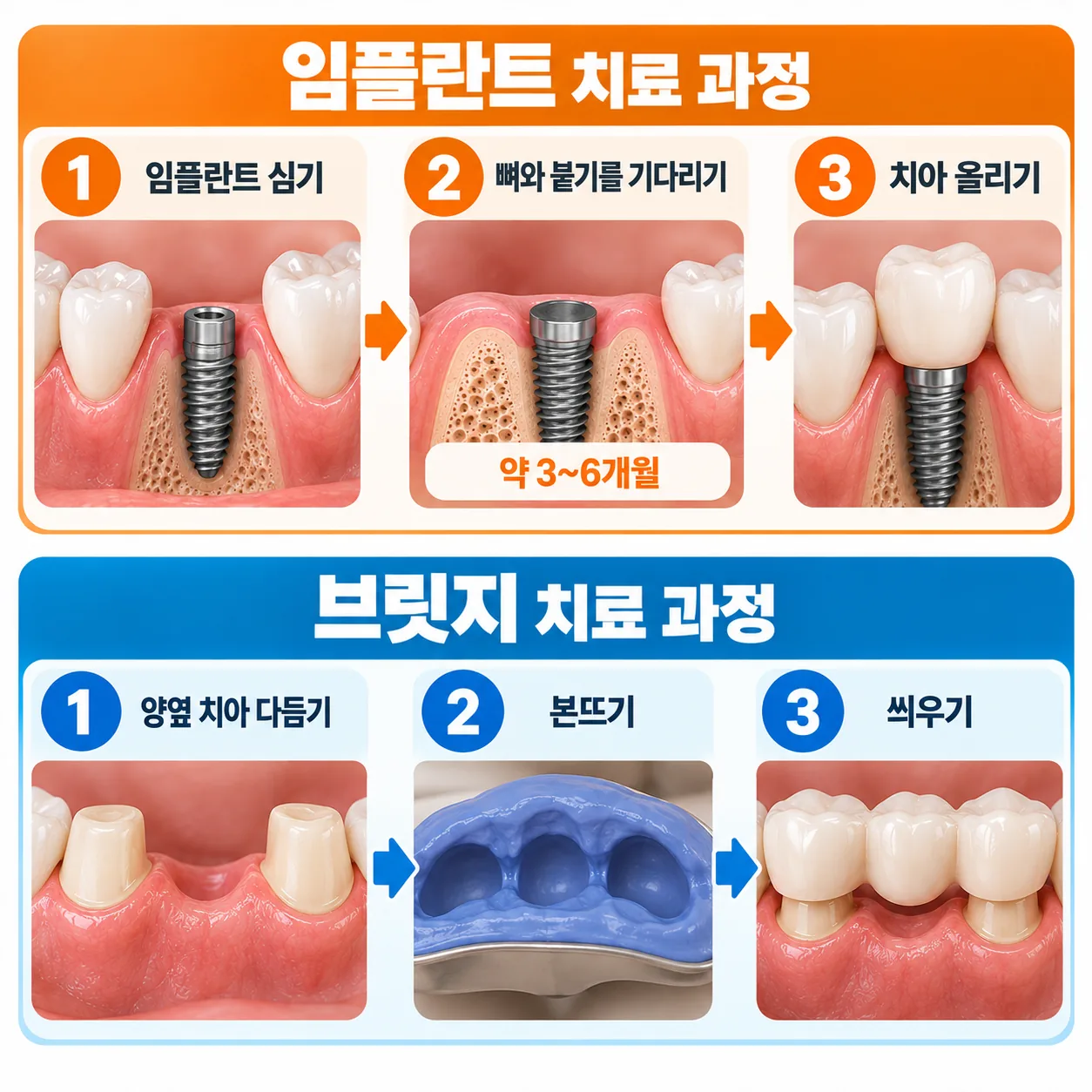 임플란트와 브릿지의 치료 단계와 기다리는 기간을 두 줄로 보여 주는 일정 흐름도