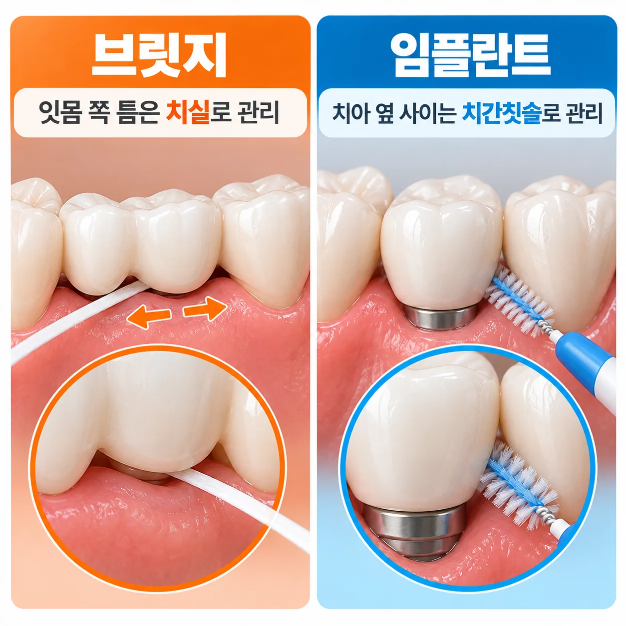 브릿지 잇몸 쪽 틈을 치실로 닦고 임플란트 옆 사이를 치간칫솔로 닦는 관리 방법 그림